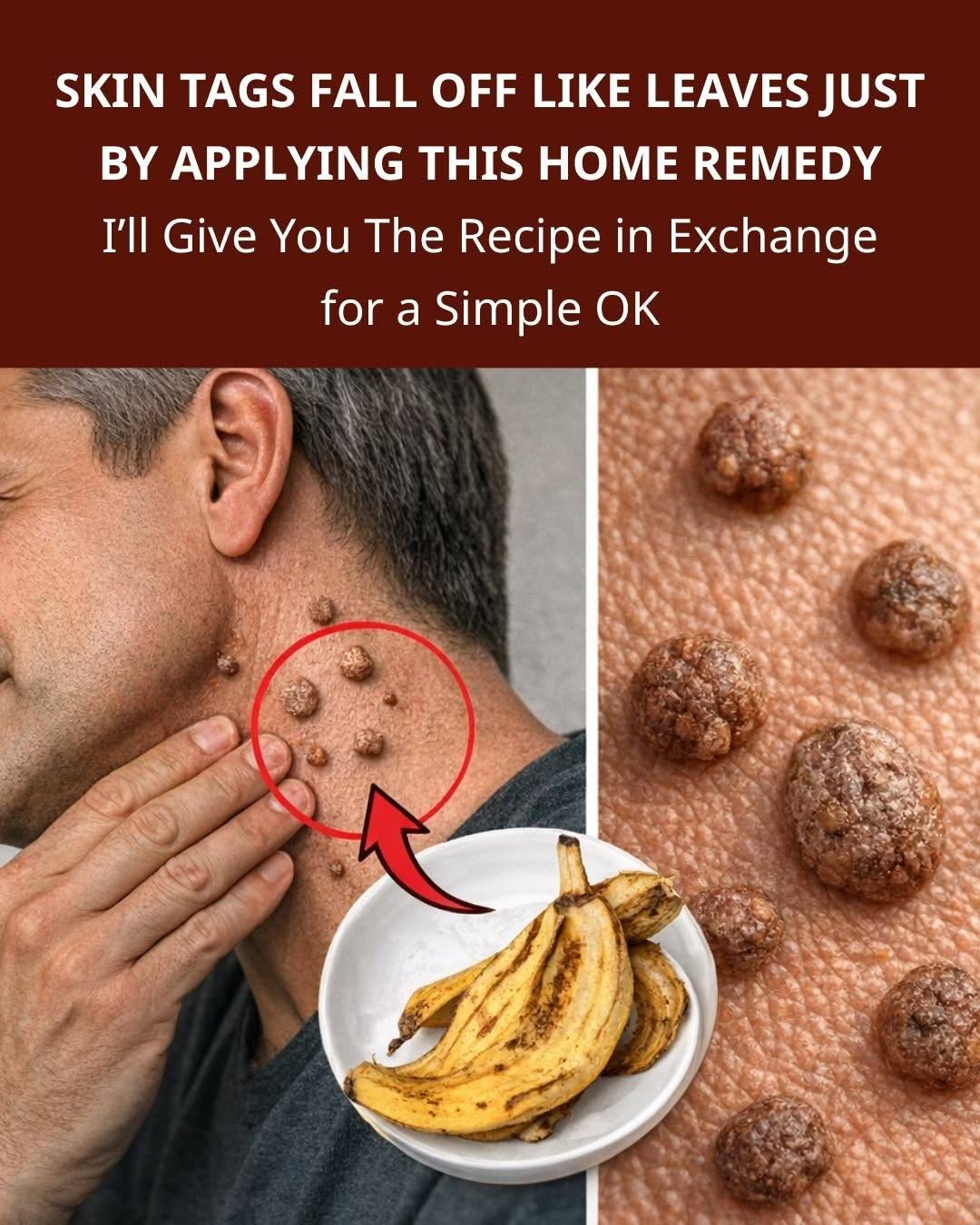 The warts will fall off like leaves simply by applying this home treatment. I’ll give you the recipe in exchange for just one word, 2