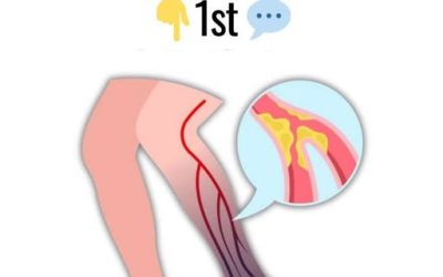 Understanding Leg Swelling: Causes, Symptoms and When to Seek Help1