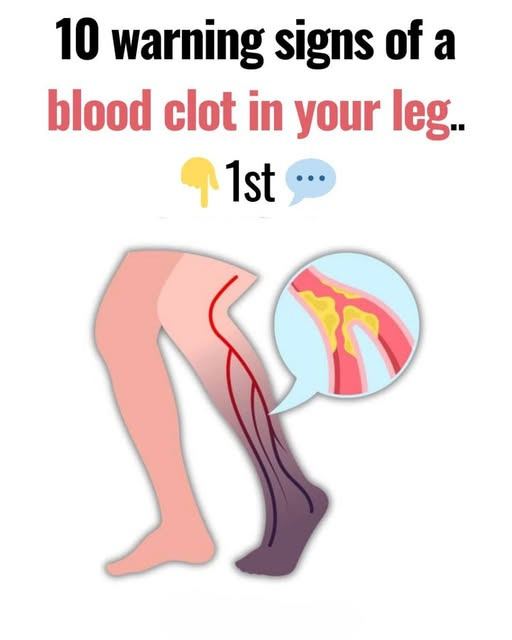 Understanding Leg Swelling: Causes, Symptoms and When to Seek Help2
