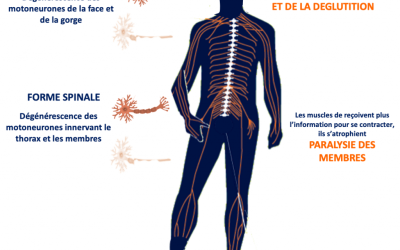 Symptoms, progression and life expectancy with Charcot’s disease 1